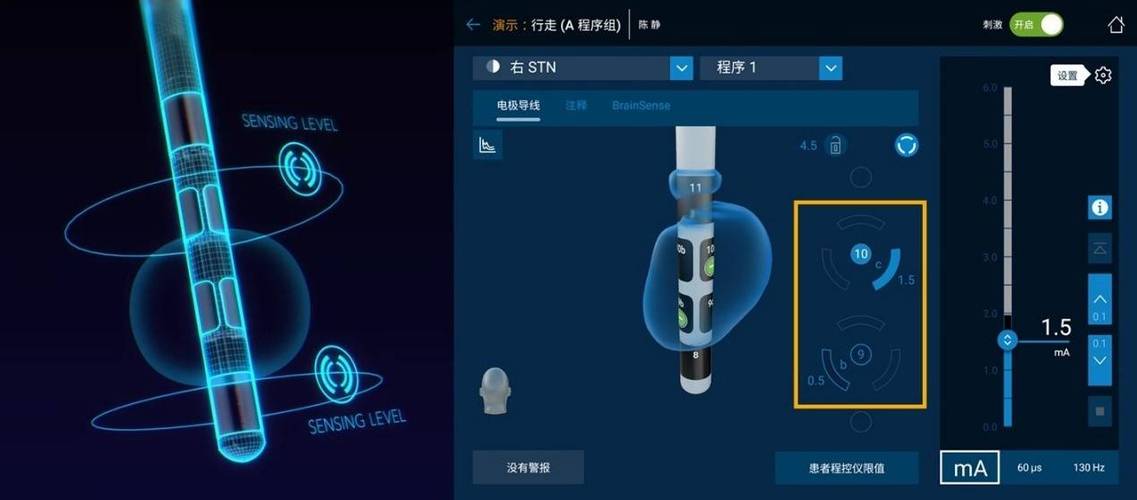 全球首个具有大脑感知功能的方向性电极系统SenSight 国内医院开启临床应用